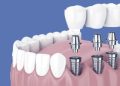 How To Find The Best Dental Implant Dentist In Bucharest
