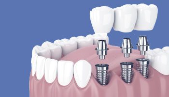 How To Find The Best Dental Implant Dentist In Bucharest