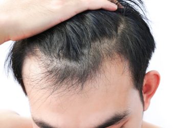 How to Effectively Recover From Hair Loss